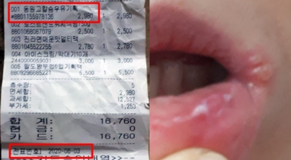 3일 우유를 구매한 구매영수증(왼쪽)과 지속되는 설사 증세로 면역력이 떨어져 A씨의 입 주변에 포진형 피부염이 발생한 모습 (사진=A씨 제공)